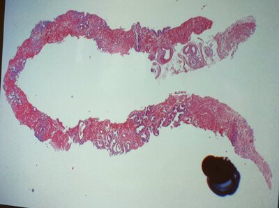 Aufbereitete Gewebeentnahme zur mikroskopischen Bestimmung 