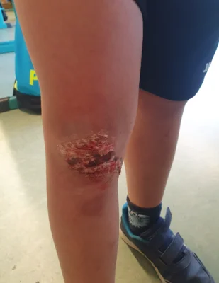 Vorschaubild: verletzung nach einem Fahrradsturz