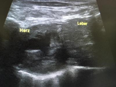Ultraschallbild Herz und Leber (Bild vergrößern)