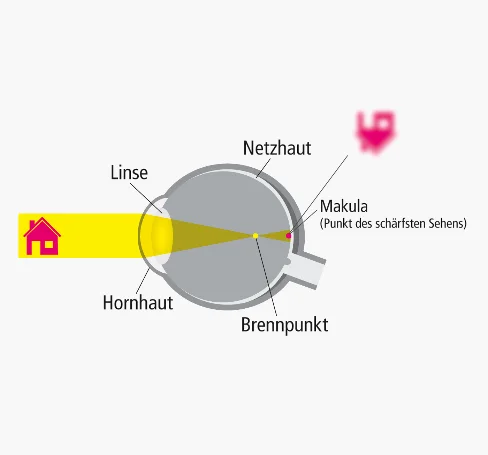ein kurzsichtiges Auge
