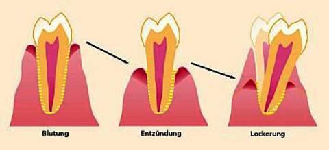 Parodontitisverlauf schematisch
